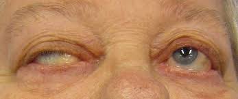 A person with Myasthenia Gravis